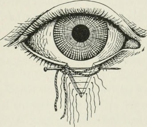 behandeling van ectropion houdt in dat er een taartvormig puntje uit het ooglid gehaald wordt.