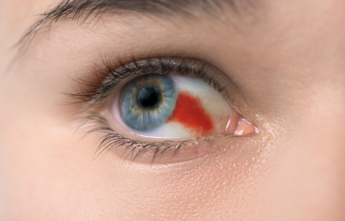 Gescheurd bloedvat in het oog leidt tot een egale rode vlek in het oogwit.