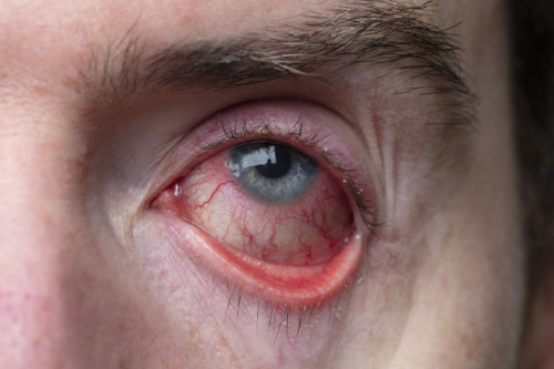 Een ontstoken oog waarbij de bloedvaten wijd open zijn gaan staan.